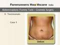 Tummy Tuck (Abdominoplasty)