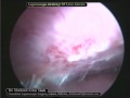 Laparoscopic Liver Abscess Drainage.wmv