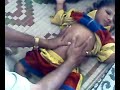 A child with physical deformity(Pigeon Chest)