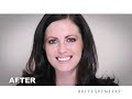 Teeth Alignment: a complete procedure