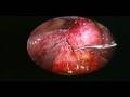 Laparoscopic Cholecystectomy in a case of cholecystoduodenal fistula