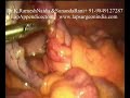 Laparoscopy Appendicectomy Video ( Keyhole / Lap Appendix) Laparoscopy Appendicectomy Video ( Keyhole / Lap Appendix)