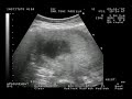 ECOGRAFIA. BEBE 15 SEMANAS ECOGRAFIA. BEBE 15 SEMANAS