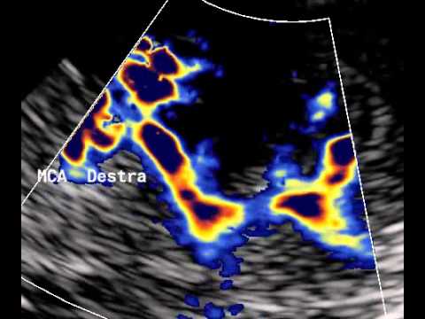 how to perform mca doppler
