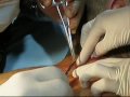 HegTetoválás -  SCAR EN RAIJIN TATTOO