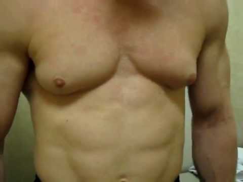 how to treat gynecomastia from steroids