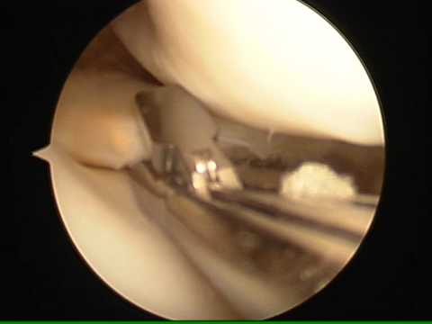 how to treat knee cartilage damage