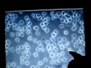 Polarity and motility of cancerous B lymphocytes Polarity and motility of cancerous B lymphocytes