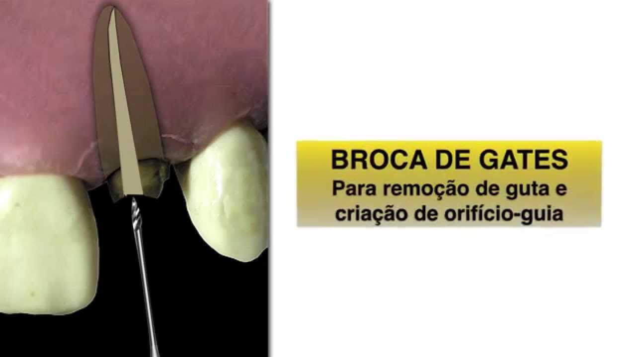 Como fazer um preparo intra-canal para Pinos de Fibra de Vidro sem usar brocas especiais