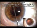 catarata-ifis-sindrome-iris-flacido-intraoperatorio.html