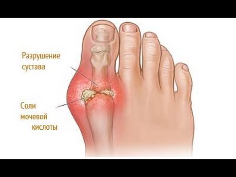 Как лечить артроз пальца в домашних условиях Как лечить артроз пальца в домашних условиях