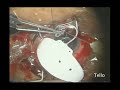 Baerveldt Implant