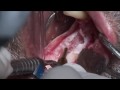 IMPIANTI IN MANDIBOLA RIGENERATA CON INNESTO A BLOCCO E CHIRURGIA GUIDATA.