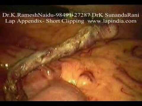 Short Clips of  Various Laparoscopy ...