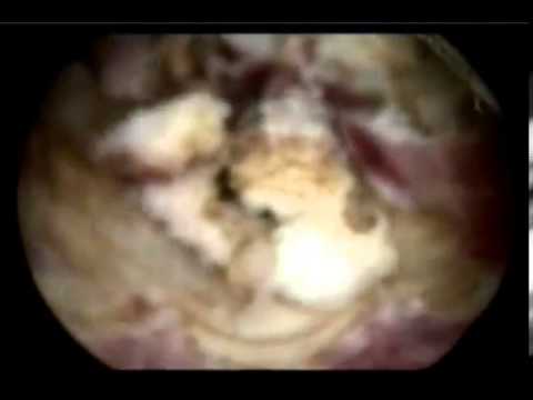 how to treat eosinophilic folliculitis