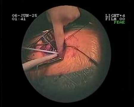 Clinical smartcanula® application ...
