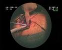 www.smartcanula.comClinical smart canula® application with Seldinger technique for remote cannulation- puncture of the femoral vein- guide wire insertion- tip positioning in the superior vena cava- stepwise dilatation of the access orifice- Smartcanula® collapsed (stretched) with mandrel- smart canula® insertion over the wire- guide wire removal- mandrel removal- smart canula® expands spontaneously