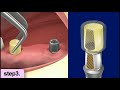 Dental implants procedure video - restoration