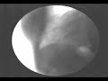left lung has  a large white round mass !!what is it?le poumon gauche a une grosse masse ronde et blanche !! qu'est-ce que c'est?
