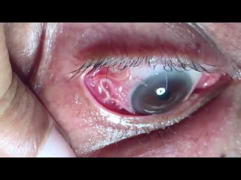 Sán chó dài 15cm ký sinh trong mắt người