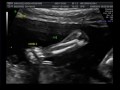 Twins Ultrasound Week 19 B/G Fraternal -Video 3 of 3