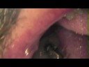 severe periodontitis severe periodontitis