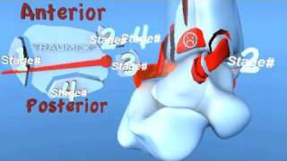 Lauge Hansen PER Pronation External Rotation (Eversion) Ankle Fracture