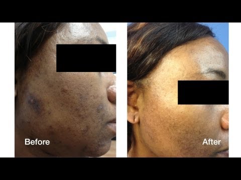 how to treat ipl laser burns