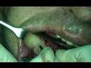 implant dental video preview 09