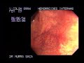 http://www.officialhealthtips.com

Video Hemorrhoids rubber band ligation 1

Other hemorrhoids surgery types:
hemorrhoidectomy, laser coagulation, infrared photocoagulation, injection sclerotherapy, rubber band ligation, doppler Guided Hemorrhoid Artery Ligation


http://www.officialhealthtips.com