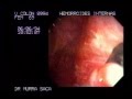 Video Hemorrhoids rubber band ligation 1