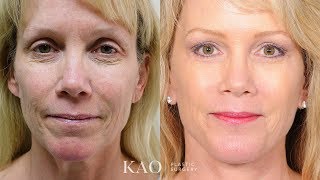 Kao Plastic Surgery - PONYTAIL LIFT™ - Plastic Surgery - Facelift with Real Long Lasting Results!