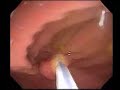 Colon Polyp Removal with Dr. Galati Colon Polyp Removal with Dr. Galati