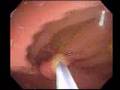 Colon Polyp Removal with Dr. Galati