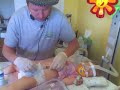 Spinal Muscular Atrophy - Mickey Button Change Out