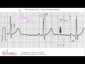 ECG Interpretation, Interval Measurements, Part 6-4 