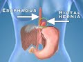 Conditions That Cause Heartburn (Health Short)