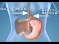 smoking and heartburn