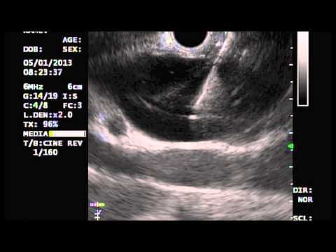 how to drain biliary drain