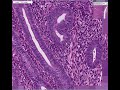 Histopathology Uterus, endometrium--Proliferative endometriu Histopathology Uterus, endometrium--Proliferative endometriu
