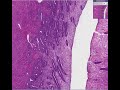 Histopathology Uterus, endometrium--Proliferative endometriu