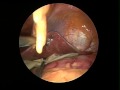 Single Skin Incision (SPA) Hepatic Sling Insertion