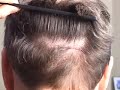 Hair transplant donor closure, trichophytic 4
