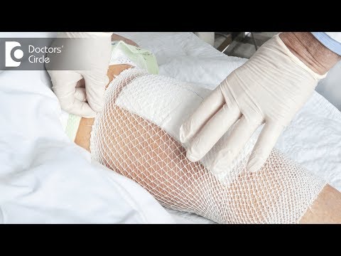 how to decide to have knee replacement surgery
