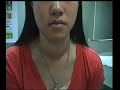 Goiter minimization under Thyroid Throu - Case3 before