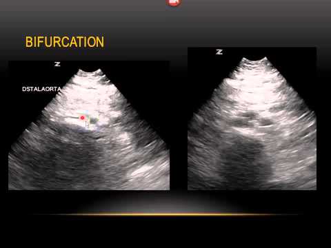 how to locate the aorta
