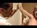 Iowa City Plastic Surgery Live: Arm Lift 1 of 14