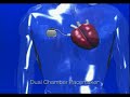 Hypertrophic Cardiomyopathy - Treatment - PacemakersPart of the Hypertrophic and Dilated Cardiomyopathy DVD by the Cardiomyopathy Association (c) 2002