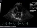 Atrioventricular (AV) canal defect