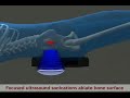 Bone Mets (Bone Metastases) MRgFUS Treatment Bone Mets (Bone Metastases) MRgFUS Treatment